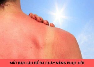 mất bao lâu để da cháy nắng phục hồi