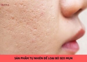 sản phẩm tự nhiên để loại bỏ sẹo mụn