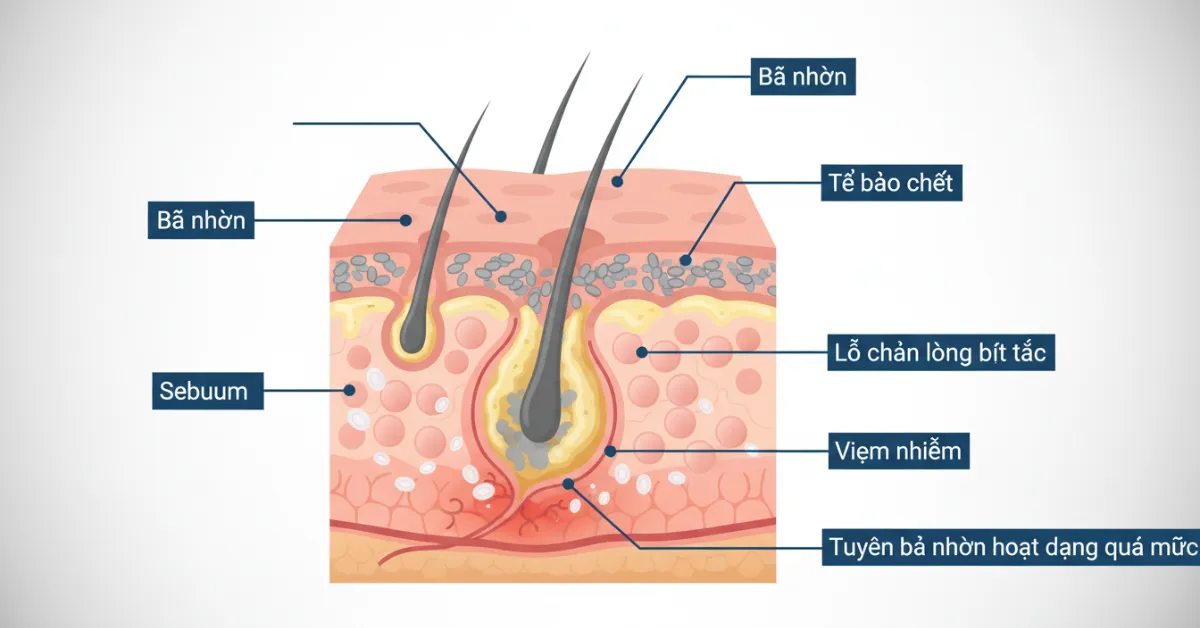 Vì sao da dễ nổi mụn dù đã skincare
